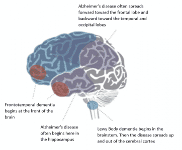 Characteristics of Frontotemporal Dementia | DEAL